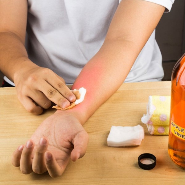 how to stop pepper spray burn on skin