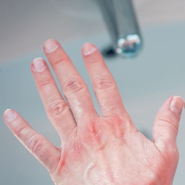 how to stop pepper spray burn on skin